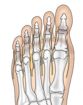 Morton Neurom