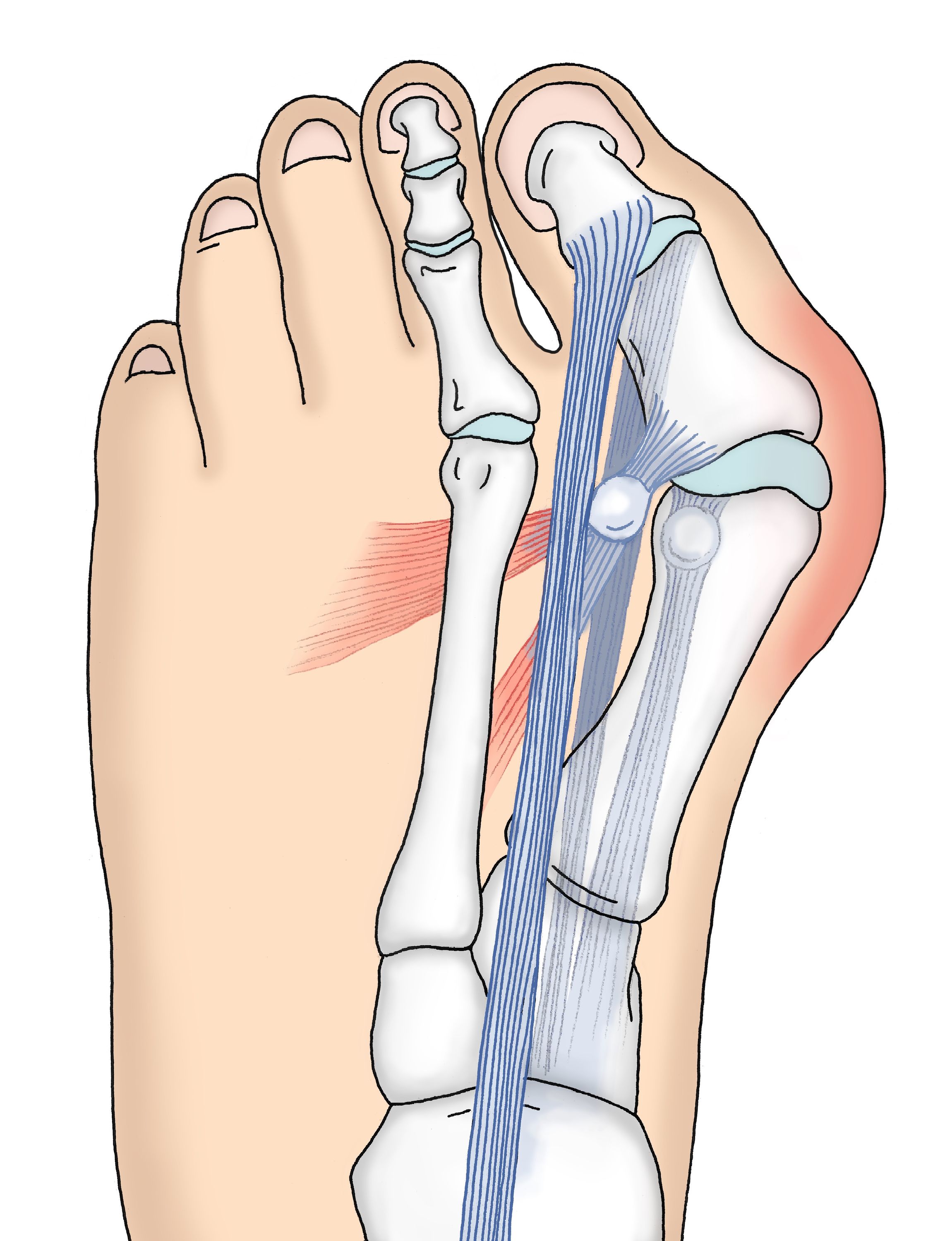 Hallux valgus - Ansicht von oben