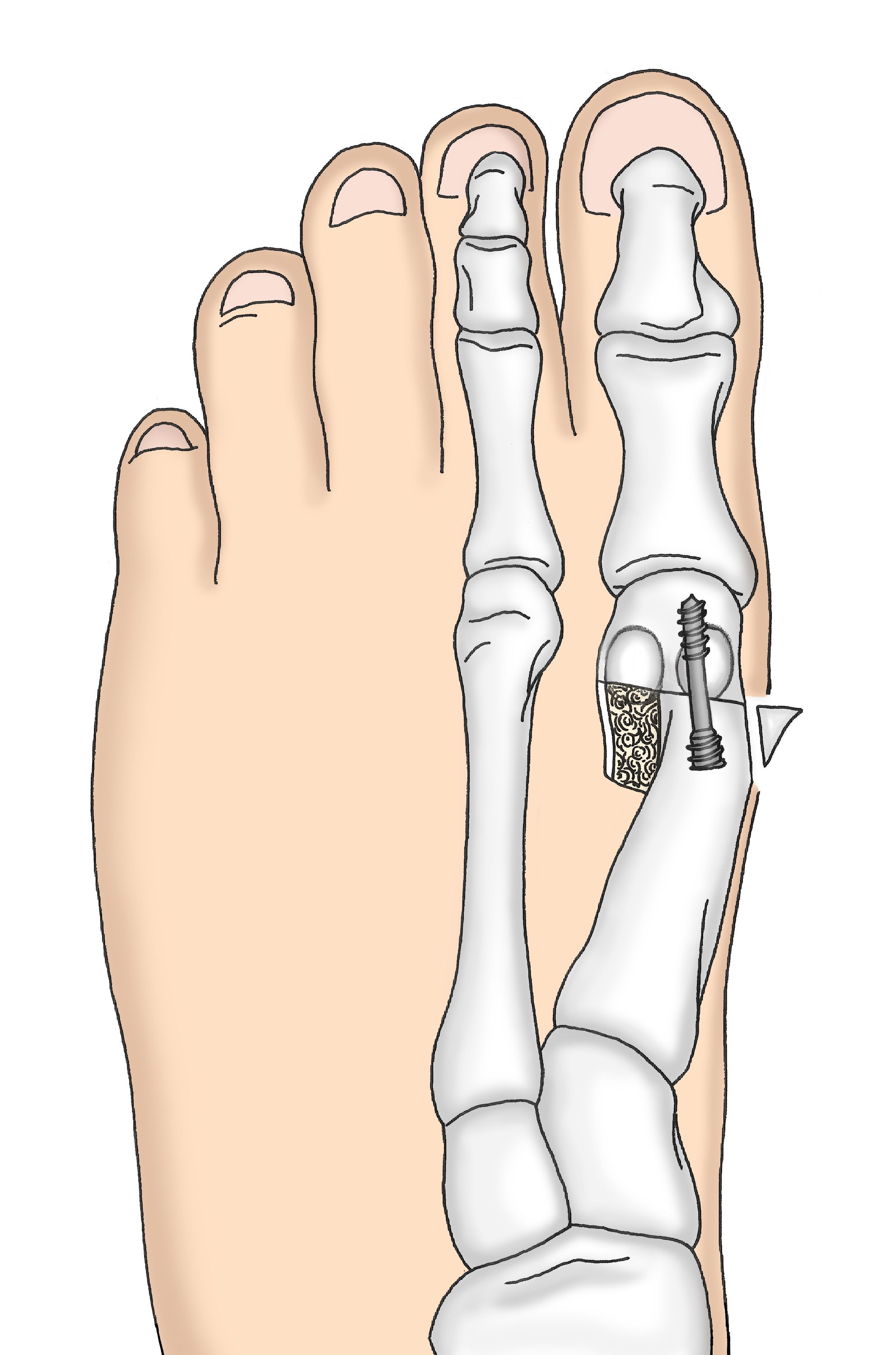 Operation bei mildem und mittelschwerem Hallux valgus - Ansicht von oben