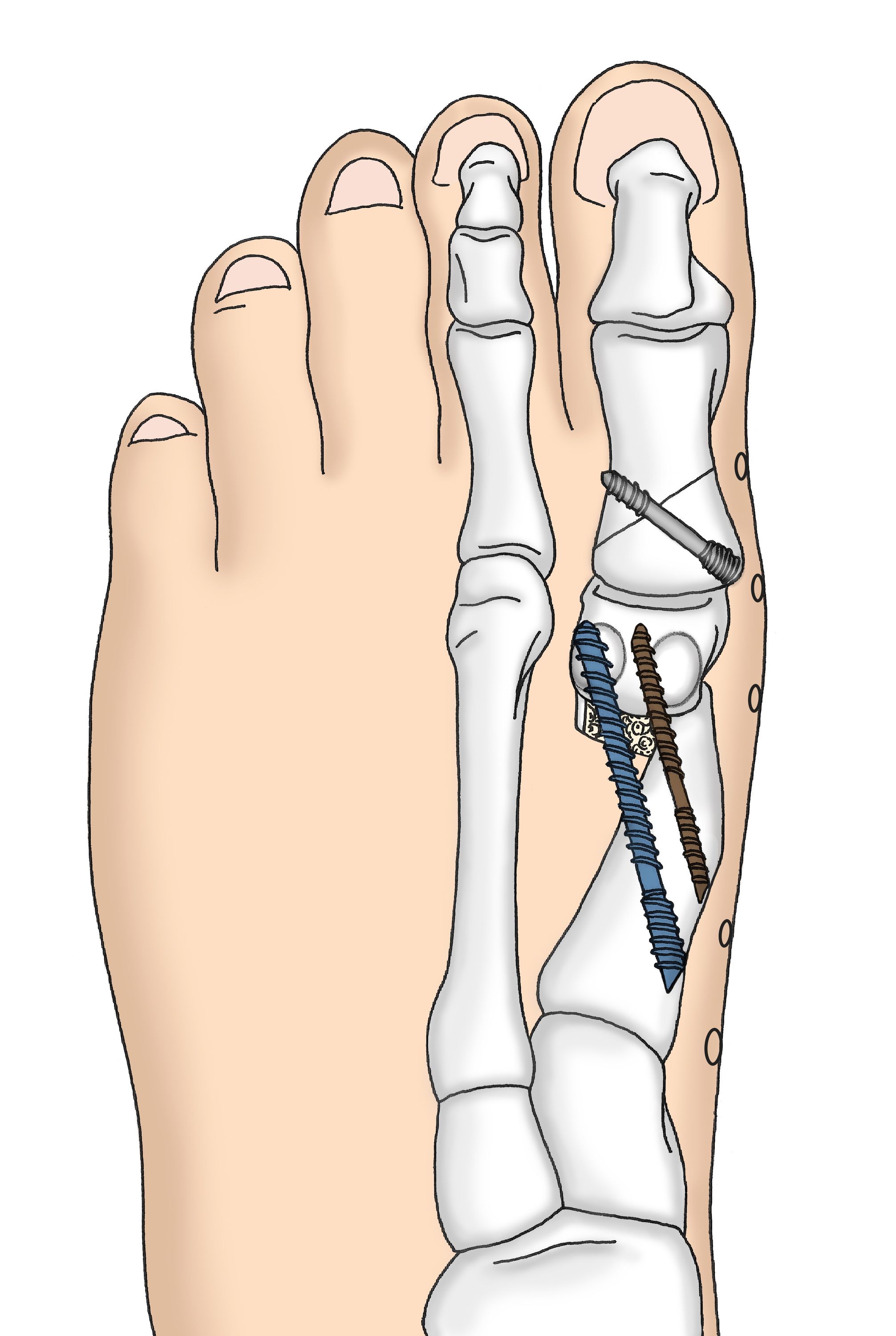 Site Line Analytiker Balkon hallux valgus schraube Mitwirkender ...